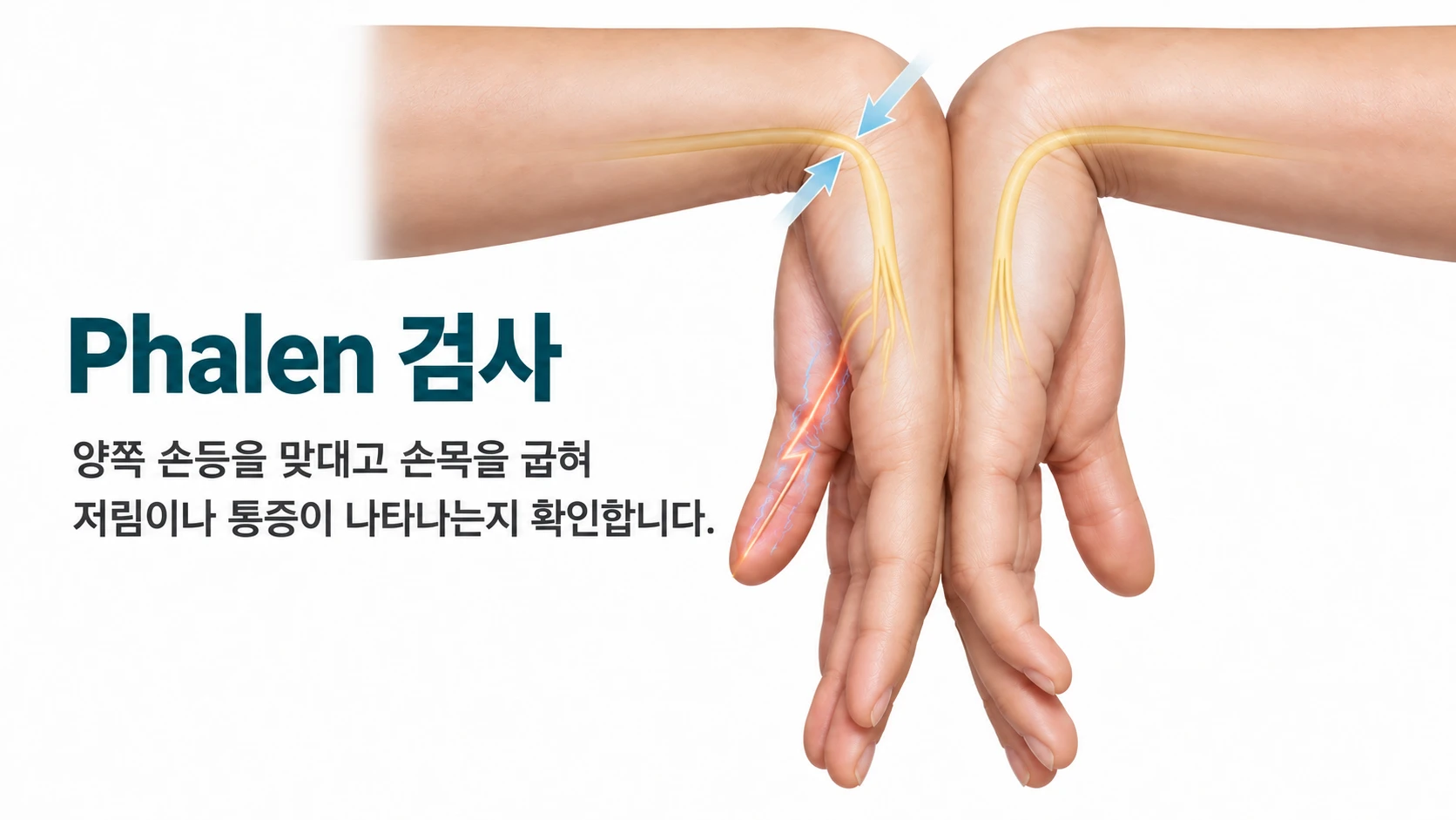 Phalen 검사 그림 — 양쪽 손등을 맞대고 손목을 굽혀 저림이나 통증이 나타나는지 확인하는 모습