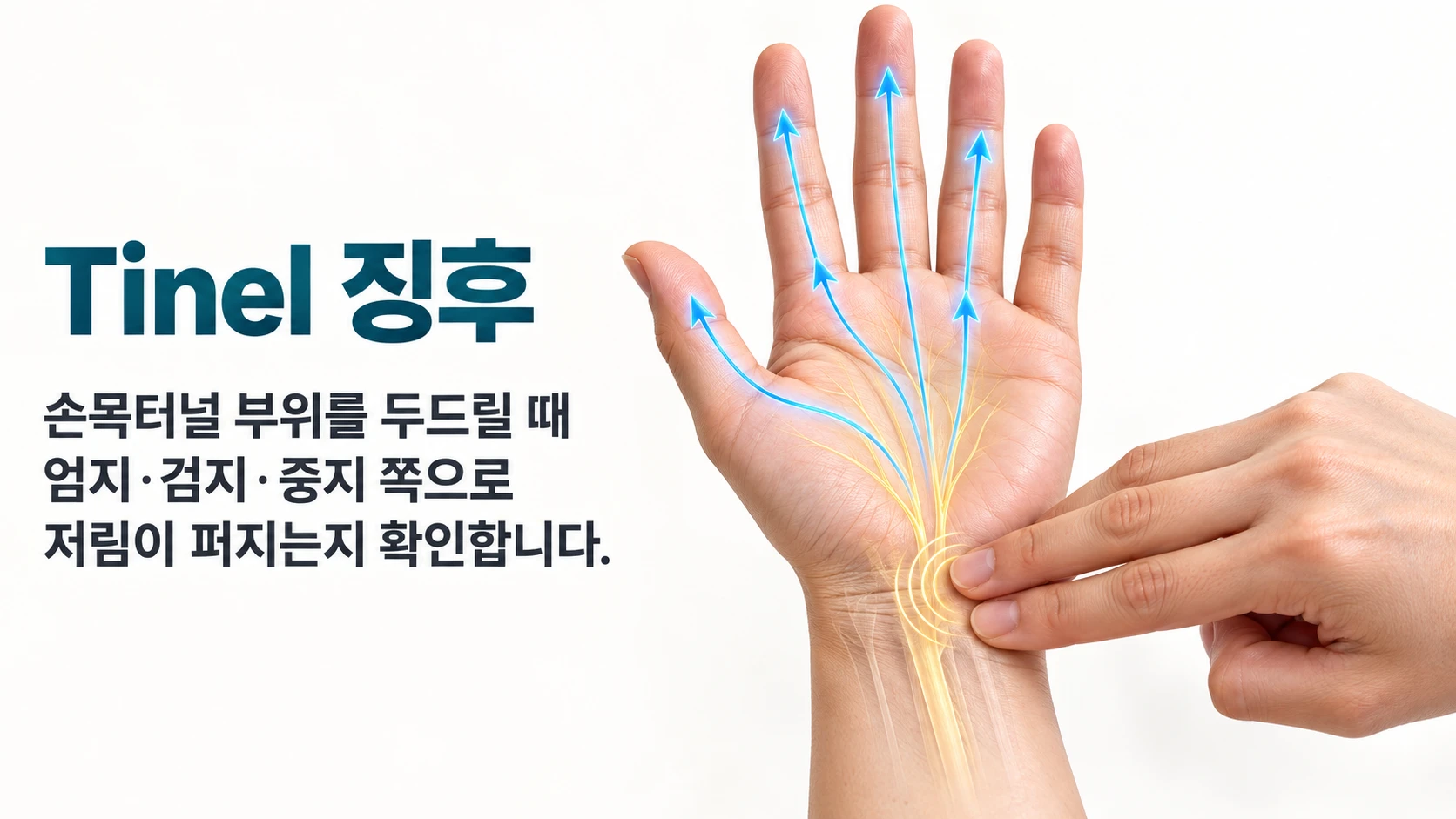 Tinel 징후 그림 — 손목터널 부위를 손가락으로 두드릴 때 엄지 · 검지 · 중지 쪽으로 저림이 퍼지는지 확인하는 모습