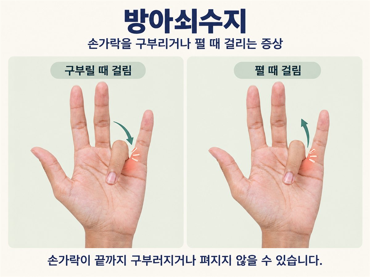 방아쇠수지 — 손가락을 구부리거나 펼 때 걸리는 증상, 손가락이 끝까지 구부러지거나 펴지지 않을 수 있습니다