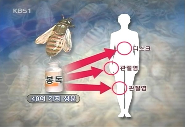 KBS 방송 화면 — 디스크와 관절염을 치료하는 봉침
