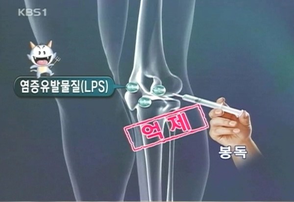 KBS 방송 화면 — 봉침에 의한 염증유발물질 억제