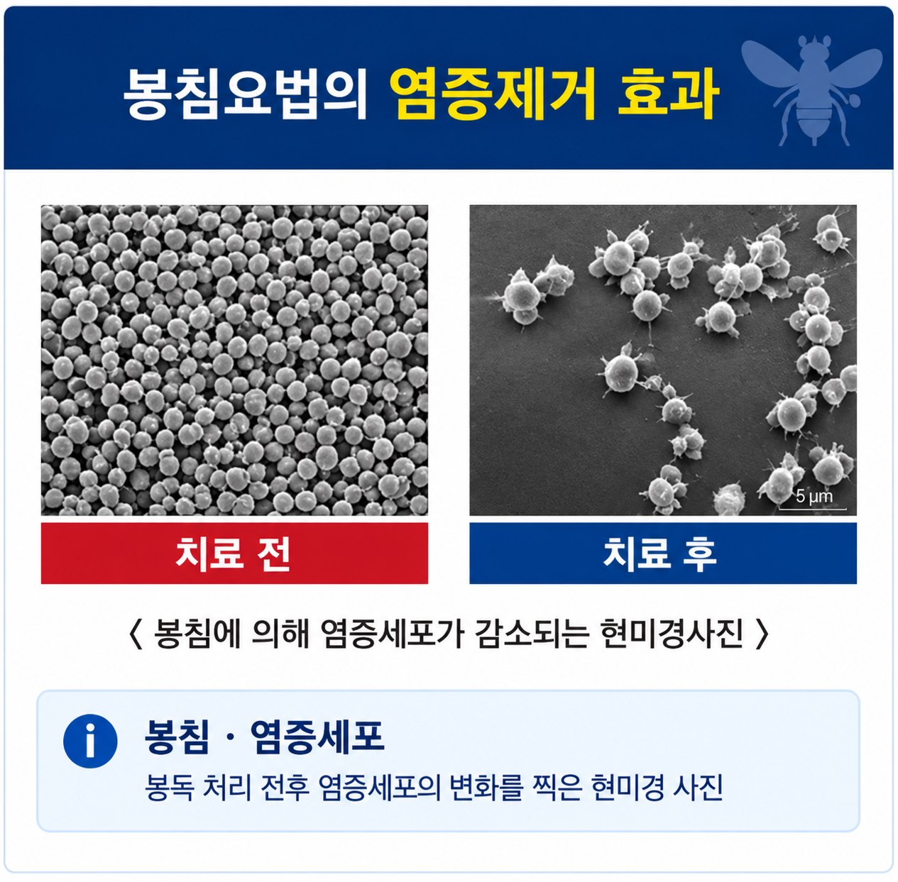 현미경 사진 두 장 — 왼쪽 치료 전은 염증세포가 빽빽하게 차 있고, 오른쪽 치료 후는 염증세포가 드문드문 남아 있음