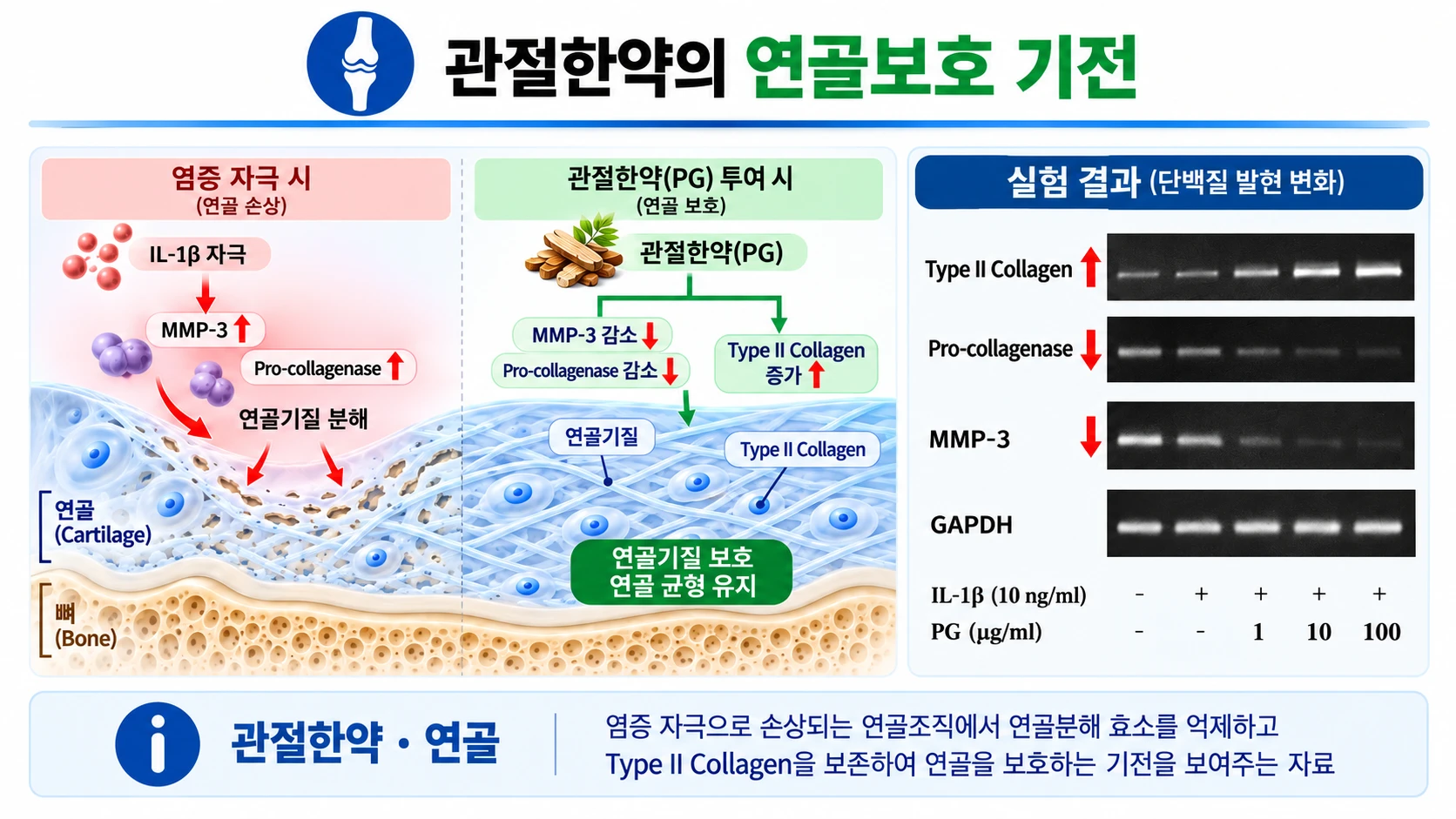 관절한약의 연골보호 기전 — 염증 자극(IL-1β) 시에는 MMP-3 · Pro-collagenase 가 늘어 연골기질이 분해되고, 관절한약(PG)을 투여하면 MMP-3 · Pro-collagenase 가 줄고 Type II Collagen 이 늘어 연골기질이 보호됩니다. 실험 결과(단백질 발현 변화): PG 1 · 10 · 100 μg/ml 에서 Type II Collagen 증가, Pro-collagenase · MMP-3 감소, GAPDH 는 일정. 염증 자극으로 손상되는 연골조직에서 연골분해 효소를 억제하고 Type II Collagen 을 보존하여 연골을 보호하는 기전을 보여주는 자료